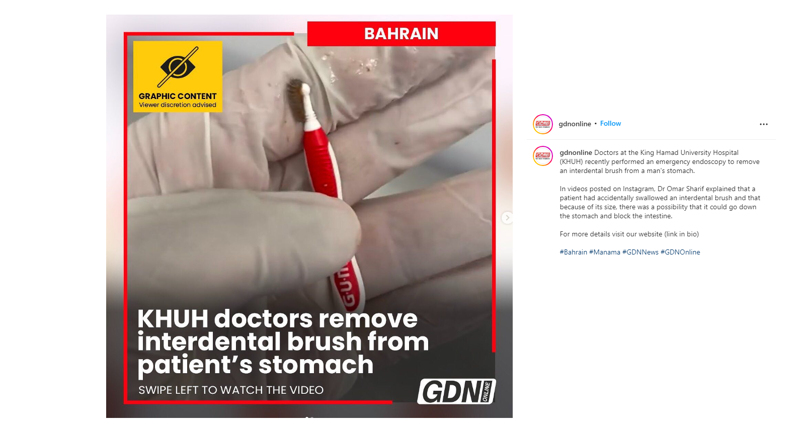 KHUH doctors remove interdental brush from patients stomach 